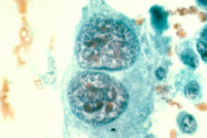 osteosarcoma, bone cancer